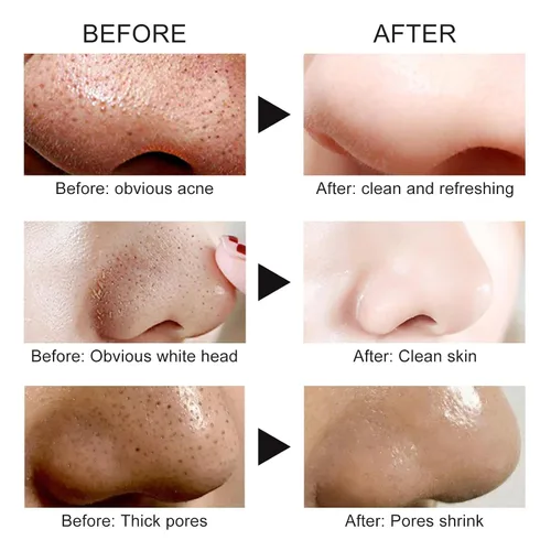 Vista 4 de Mascarilla para Puntos Negros Removedor, Mascarillas para La Cara Facial, Crema para Puntos Negros en La Cara, Removedor de Cabeza Blanca Negra