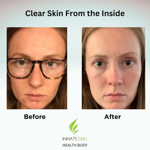 Vista 3 de Clear Skin - Paquete de vitaminas para el acné 20 antioxidantes, botánicos, minerales y vitaminas Pastillas hormonales y quísticas para el acné