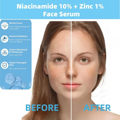 Vista 2 de Niacinamida 10% + Zinc 1% suero para la cara – Control de aceite, acné, reductor de poros y reducción de imperfecciones – Suero facial ligero,