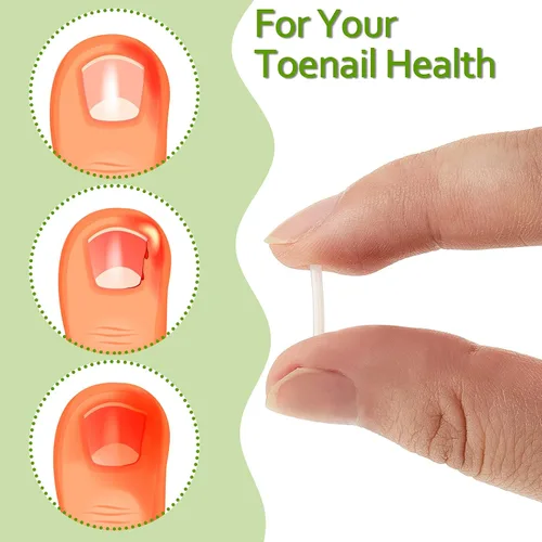 Vista 6 de 100 tiras correctoras de uñas encarnadas, parches de corrección de uñas de los pies, parches curvos para enderezar las uñas de los pies, clips