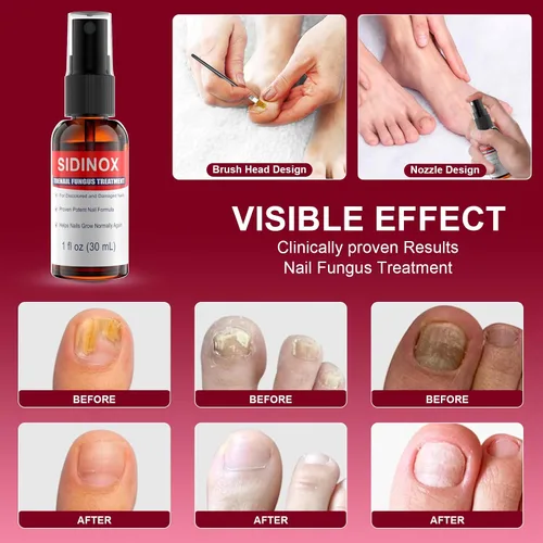 Vista 4 de Tratamiento de hongos en las uñas de los pies, tratamiento extra fuerte con 25% de ácido undecilénico, tratamiento de hongos en uñas dañadas, uñas