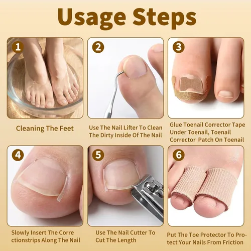 Vista 7 de Juego de corrector de uñas encarnadas con tiras correctoras y lima sin dolor, kit profesional de eliminación de uñas encarnadas con herramienta