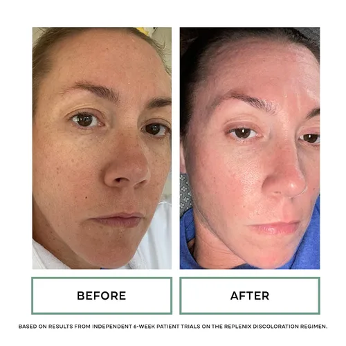 Vista 5 de Replenix Limpiador facial rejuvenecedor con ácido glicólico, suave lavado facial exfoliante de grado médico para decoloración de la piel