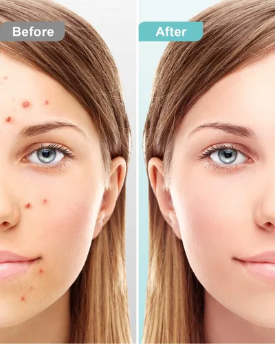 Vista 3 de Herramientas removedoras de puntos negros para Face EZBASICS Profesional Extractor de Comedones de Acero Inoxidable para Manchas y Puntos Blancos
