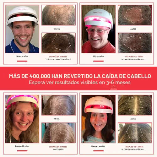 Vista 2 de iRestore Sistema de crecimiento del cabello con láser esencial: tratamientos de pérdida de cabello aprobados por la FDA para hombres y mujeres