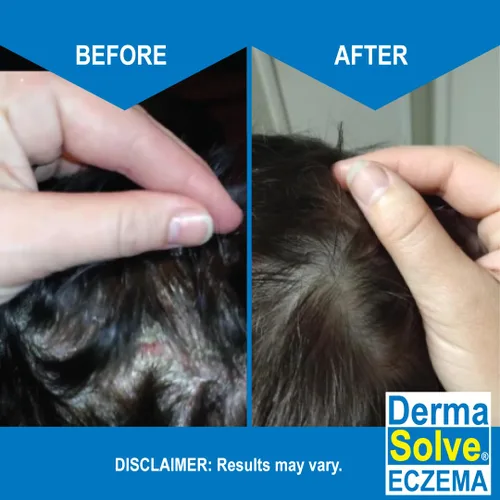 Vista 3 de Dermasolve Champú para aliviar el eccema – Terapia libre de cuero cabelludo y caspa que protege, hidrata y repara la piel para niños y adultos, sin