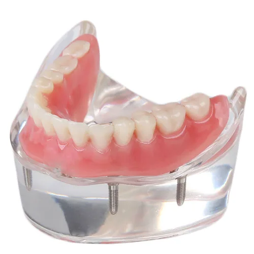 Vista 5 de Modelo de restauración dental con 4 implantes Sobredentadura Inferior Enseñanza Estudio Modelo de Dientes