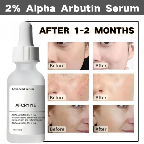 Vista 9 de Suero facial con 2% de alfa arbutina + ácido hialurónico – Suero iluminador para manchas oscuras, decoloración de cicatrices de acné y pigmentación