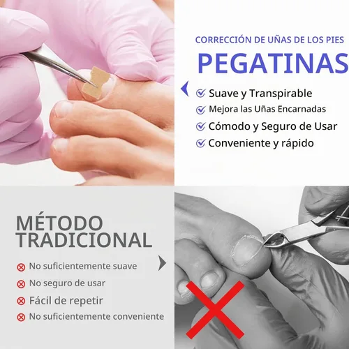 Vista 6 de Parche corrector de uñas encarnadas, 100 tiras correctoras de uñas encarnadas, parches de corrección de uñas de los pies, herramienta de tratamiento