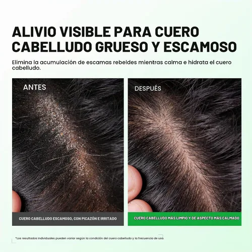 Vista 3 de RoyceDerm Spray de tratamiento de la psoriasis del cuero cabelludo