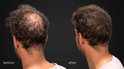 Vista 4 de Fibras capilares voluminizadoras con queratina real para adelgazar el cabello/pérdida de cabello – Dermatológicamente probado y certificado