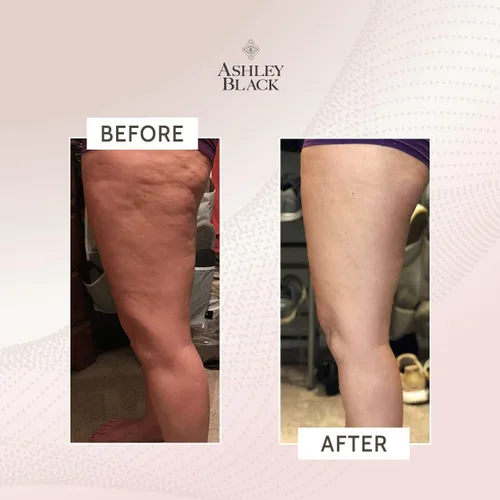Vista 3 de FasciaBlaster El ProBlaster de Mano de Ashley Black. Herramientas MioFasciales Científicamente Probadas. Masaje Suave con Resultados Efectivos.