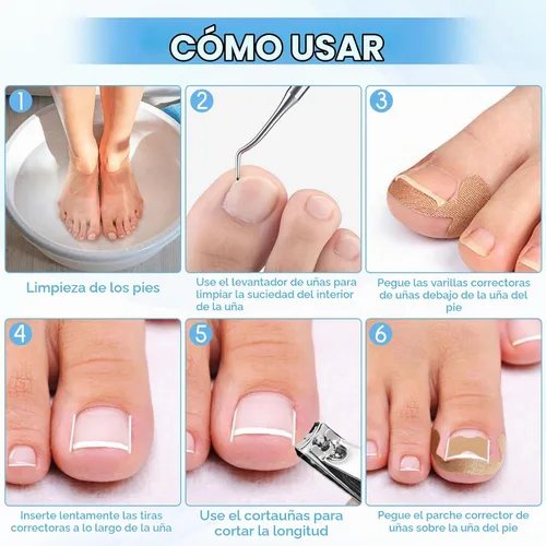Vista 4 de Kit de eliminación de uñas encarnadas con tiras de uñas encarnadas, parche corrector de uñas curvas, lima de uñas y herramientas de pedicura