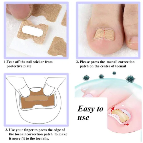 Vista 5 de Parche de corrección de uñas encarnadas, 50 calcomanías de uñas encarnadas sin pegamento para uñas encarnadas curvadas para el cuidado de los pies