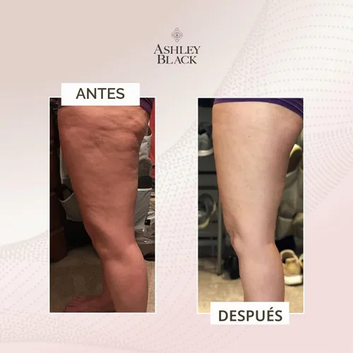 Vista 3 de FasciaBlaster El ProBlaster de Mano de Ashley Black. Herramientas MioFasciales Científicamente Probadas. Masaje Suave con Resultados Efectivos.
