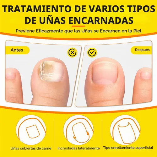 Vista 7 de Tratamiento de uñas encarnadas, corrector de uñas curvadas transpirables, tiras correctoras de uñas encarnadas con lima y levantador, kit