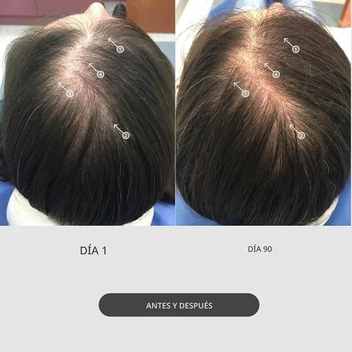 Vista 4 de Sistema de estimulación capilar con microagujas StimuROLLER de DS Labs, 0.25 mm, el empaque puede variar