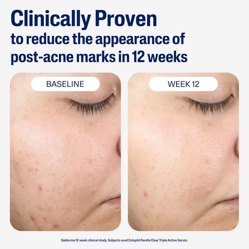 Vista 5 de CETAPHIL Suero Reparador Suave y Claro Post-Acné, Alternativa al Retinol, Suero Sin Aceite para Piel Sensible, 1 Onza Líquida, Bakuchiol, Mejora