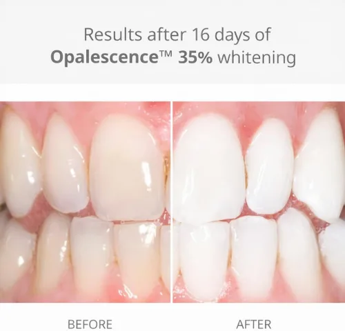 Vista 2 de Opalescence Jeringas de Gel al 35% Blanqueamiento Dental - Kit de Recarga (4 Jeringas en Total) Peróxido de Carbamida. Fabricado por Ultradent
