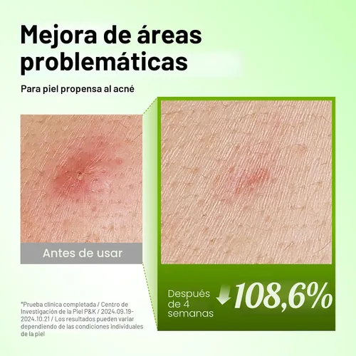 Vista 5 de Anua Suero Facial de Ácido Azelaico 10% Hialurónico en Rojo Tranquilizante, Suero Facial para Piel Sensible y Problemática, Brotes, Ácido