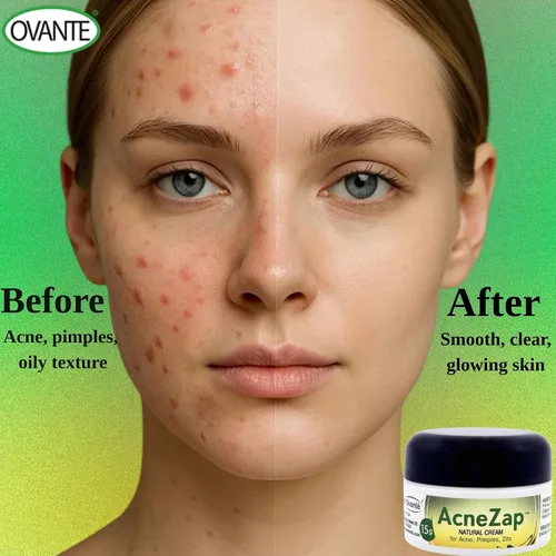 Vista 2 de Acne Zap Crema a base de azufre para cara, tratamiento eficaz del acné con azufre blanco, aceite de árbol de té y óxido de zinc para adultos