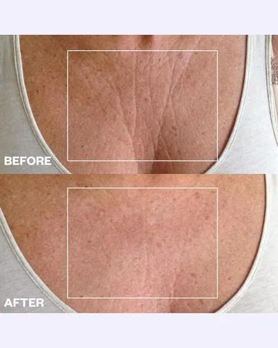 Vista 3 de Kit para arrugas schminkles Pecho Arrugas & Décolletage Arrugas, Pecho suavizar