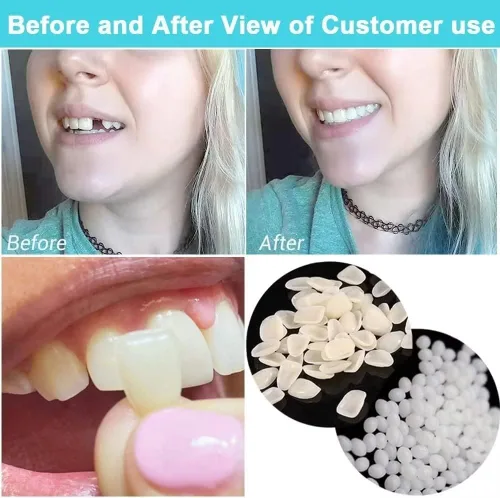 Vista 6 de womcare Kits de reparación de dientes falsos para llenar los dientes rotos y huecos que faltan - Kits de reemplazo de dientes falsos moldeables