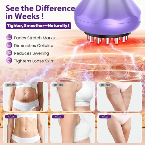 Vista 6 de Masajeador de drenaje linfático, herramienta de masaje anticelulitis para estrías de muslos y vientres y reducción de celulitis, herramientas