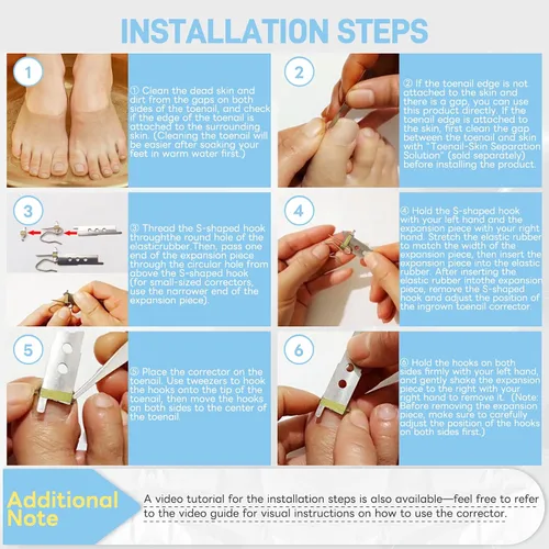 Vista 5 de InhwRior Corrector de uñas encarnadas, fácil aplicación en casa, ajuste seguro (sin deslizamiento), tracción constante para alivio rápido del dolor