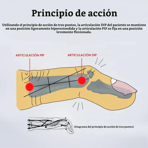 Vista 5 de SooGree 2 piezas de férula de dedo mazo soporte de dedo férula de dedo soporte protector de plástico para inmovilizador de dedos ajustable para 2