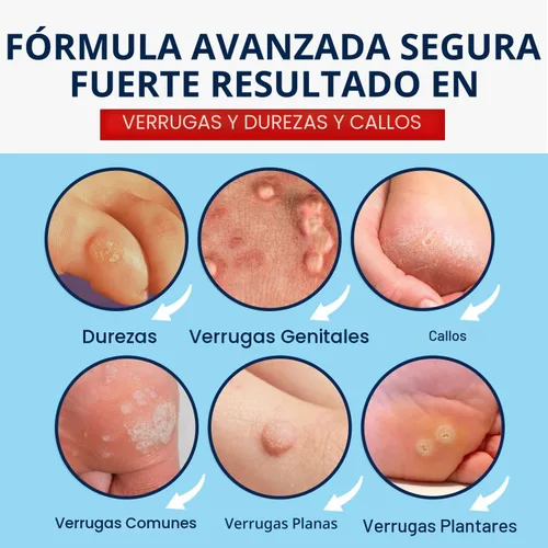 Vista 2 de MEOLY Eliminador de verrugas de acción rápida: removedor de verrugas de ácido salicílico para verrugas plantares, congelación de maíz de acción