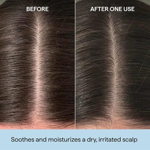 Vista 2 de Briogeo Scalp Revival Rosemary Pre-Wash Oil Moisturizing Scalp Treatment for Dry, Flaky, or Itchy Scalp Strengthens Hair & Soothes Scalp Vegan