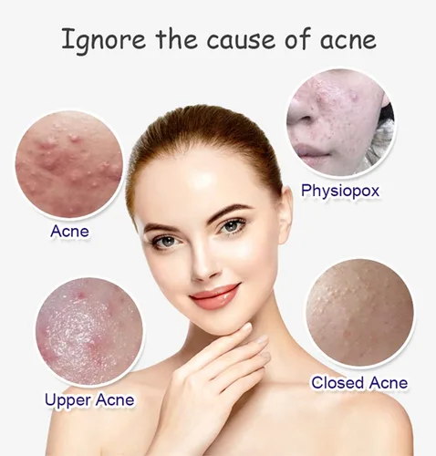 Vista 3 de AICHUN BEAUTY El ácido salicílico del extracto del aloe vera del suero facial anti-acné repara la piel dañada 1.0 fl oz