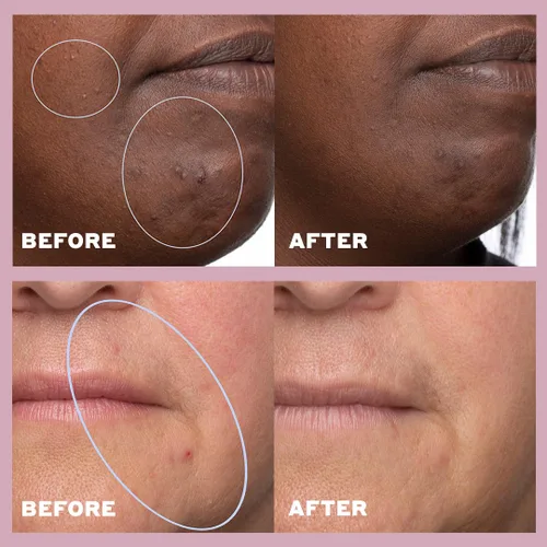 Vista 4 de Volition Beauty Skin - Suero de equilibrio y limpieza del ritmo de la piel con niacinamida + ácido salicílico Tratamiento para el acné