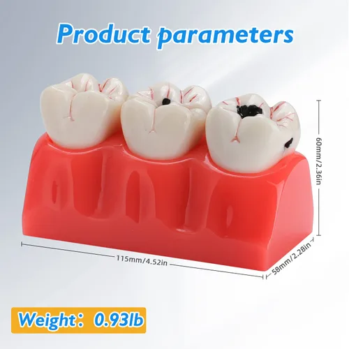 Vista 5 de Modelo de dientes de caries dentales - Modelo de caries dental extraíble 4 veces modelo de caries dental modelo de evolución de caries dental