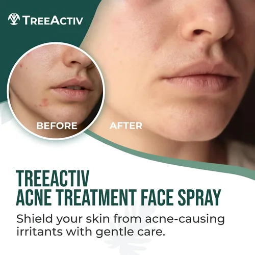 Vista 2 de Spray facial para acné, 4 onzas líquidas en aerosol facial con hamamelis, ácido salicílico para pieles propensas al acné y grasas, para acné