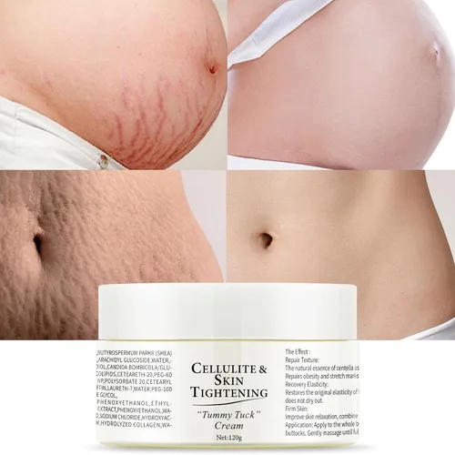 Vista 2 de Crema de eliminación de estrías para el embarazo, masajea el cuerpo y reduce la apariencia de cicatrices, eliminación de estrías suaves, cuidado