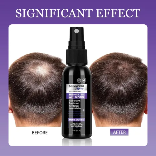 Vista 5 de Spray de minoxidil al 5% para tratamiento de crecimiento del cabello, paquete de 2, evita el adelgazamiento, promueve un cabello más fuerte y lleno