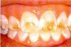 Vista 2 de D.I.Y) 10 thermo-molding "hervir y Bite Boca Bandejas por instantánea blanco Sonrisa mayorista