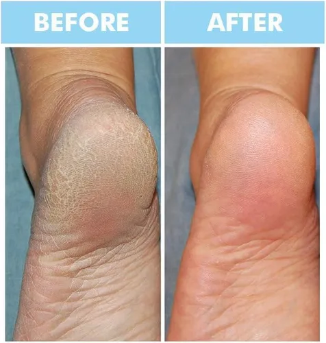 Vista 6 de Bodipure Máscara prémium para manos y pies Guantes y calcetines hidratantes Kertain Hidratante manos secas y apagadas, talones agrietados