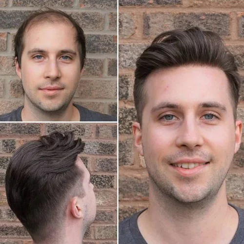 Vista 7 de Sistema de reemplazo de cabello humano para hombre, tupé para hombre, piel fina con parte superior de encaje mono y la parte trasera de poliuretano