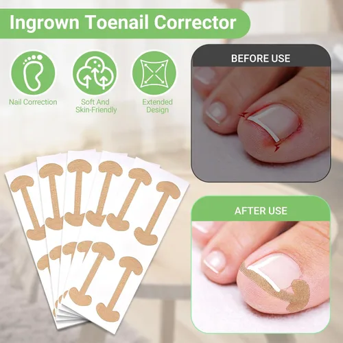 Vista 4 de Juego de corrector de uñas encarnadas con tiras correctoras, kit de herramientas profesionales para uñas de los pies, incluye tiras transpirables