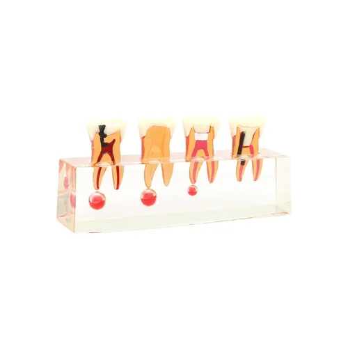Vista 2 de Modelo de tratamiento endodóntico Dentalmall, de cuatro etapas, para enseñar a estudiantes, modelo 4018