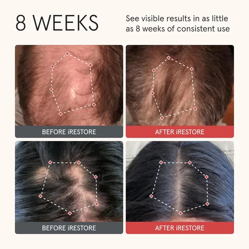 Vista 2 de iRESTORE Acondicionador de cabello biotina para cabello seco dañado, bueno para el crecimiento del cabello fino, acondicionador voluminizador