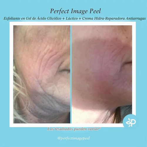 Vista 5 de Gel Peel glicólico, mejorado con retinol y extracto de té verde (10% de fuerza)