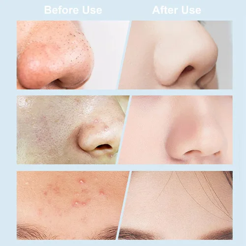 Vista 6 de Aspiradora eliminadora de puntos negros, limpiador eléctrico de poros facial 2021, herramienta extractor de acné recargable por USB, kit