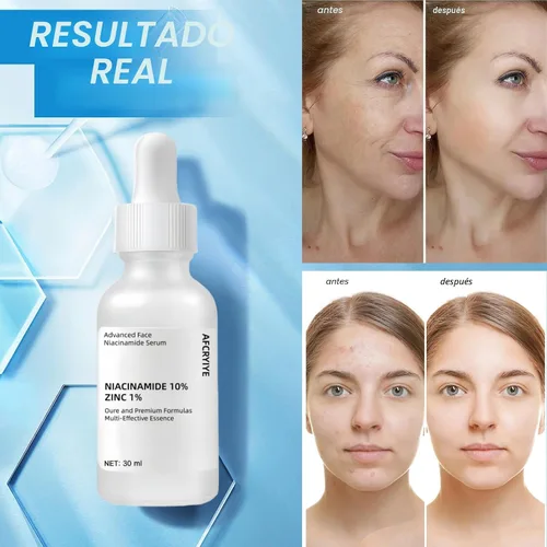 Vista 7 de Niacinamida 10% + Zinc 1% suero para la cara – Control de aceite, acné, reductor de poros y reducción de imperfecciones – Suero facial ligero,