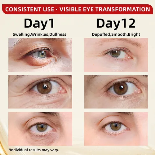 Vista 3 de Suero de ojos con cafeína para ojeras e hinchazón, antiarrugas, reafirmante y suaviza las líneas finas, tratamiento de suero de retinol debajo