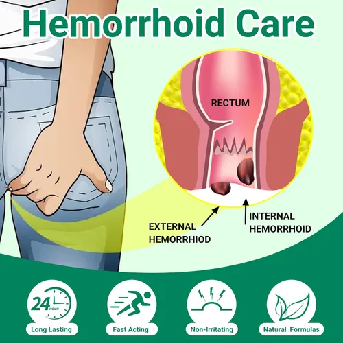 Vista 4 de LMNOOP® Ungüento para tratamiento de hemorroides, tratamiento de máxima fuerza y alivio rápido para el dolor, picazón, ardor, hinchazón, fisura