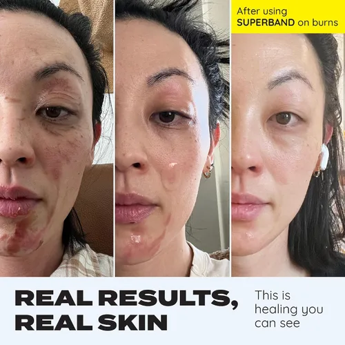 Vista 5 de SUPERBAND Premium - Vendajes hidrocoloide Premium a prueba de agua para el cuidado de heridas de MakeItSkin Finas, de curación rápida, reducen